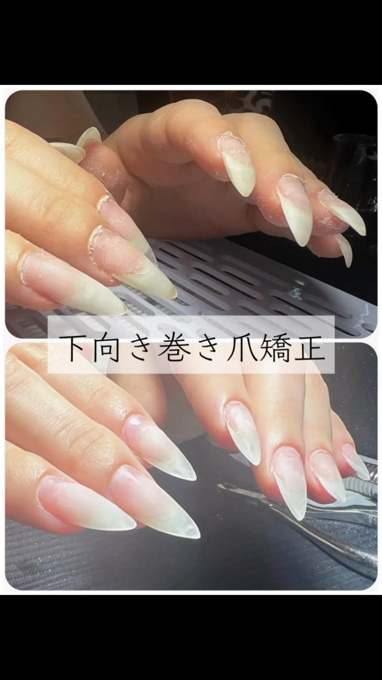 #八戸市ネイルサロン #爪矯正#ビフォーアフターネイル 